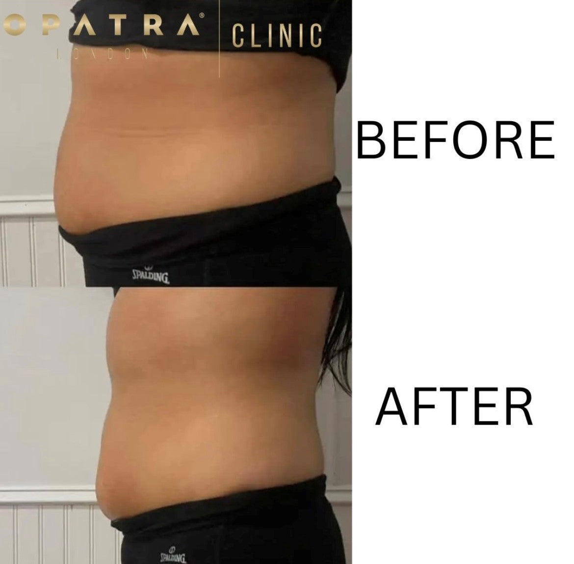 CRYOLIPOLYSIS (FAT FREEZING) **SPECIAL OFFER**